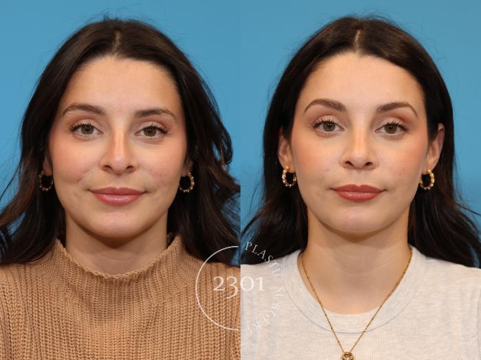 Before & After Rhinoplasty Case 933 Front View in Fort Worth, Plano, & Frisco, Texas