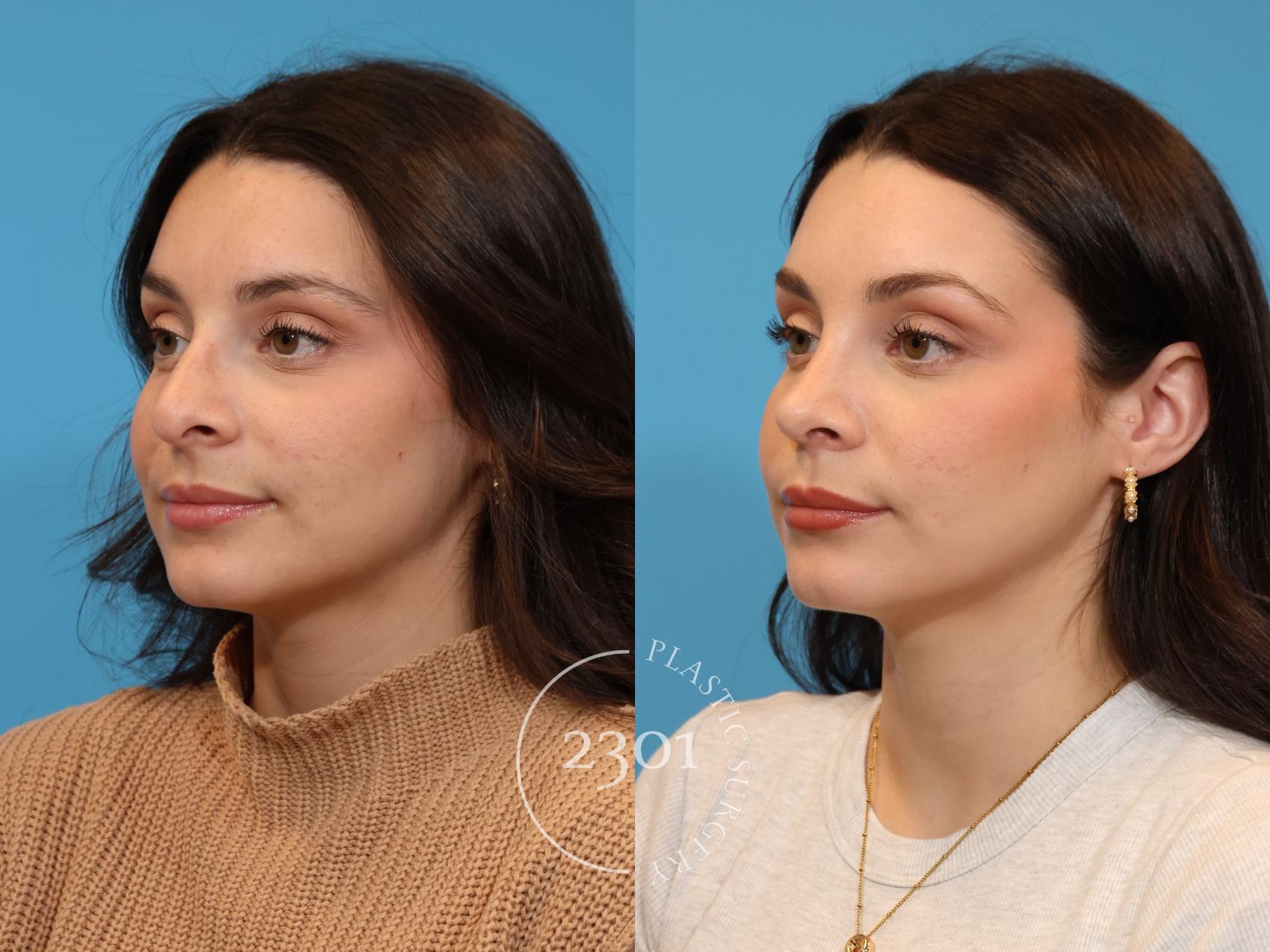 Before & After Rhinoplasty Case 933 Left Oblique View in Fort Worth, Plano, & Frisco, Texas