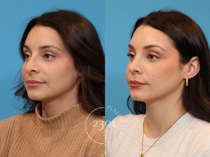 Before & After Rhinoplasty Case 933 Left Oblique View in Fort Worth, Plano, & Frisco, Texas