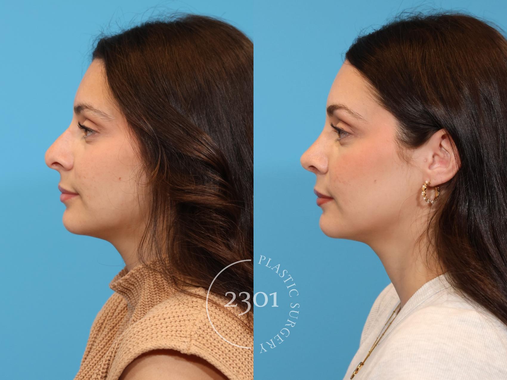 Before & After Rhinoplasty Case 933 Left Side View in Fort Worth, Plano, & Frisco, Texas