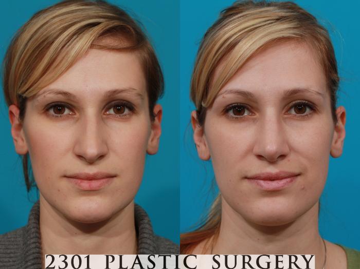 Before & After Rhinoplasty Case 94 View #1 View in Fort Worth, Plano, & Frisco, Texas