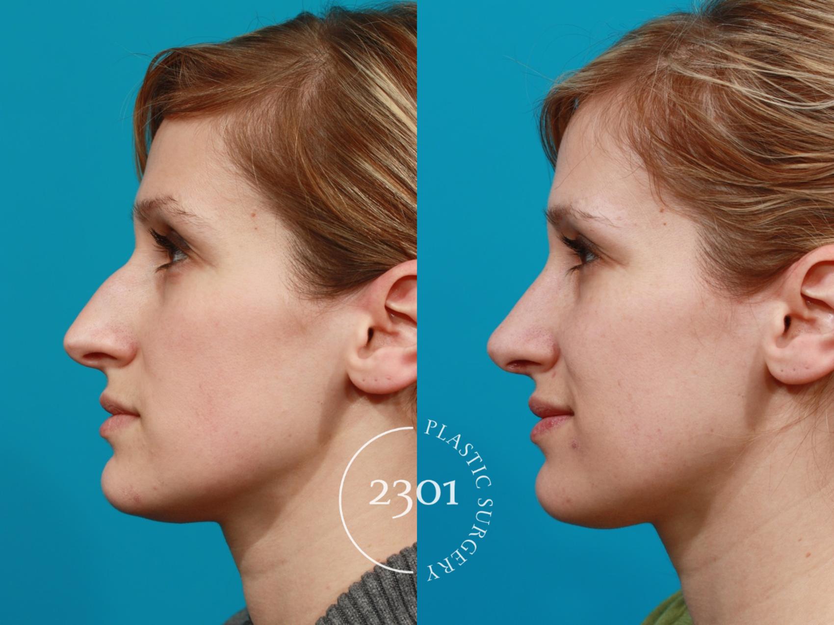 Before & After Rhinoplasty Case 94 View #2 View in Fort Worth, Plano, & Frisco, Texas