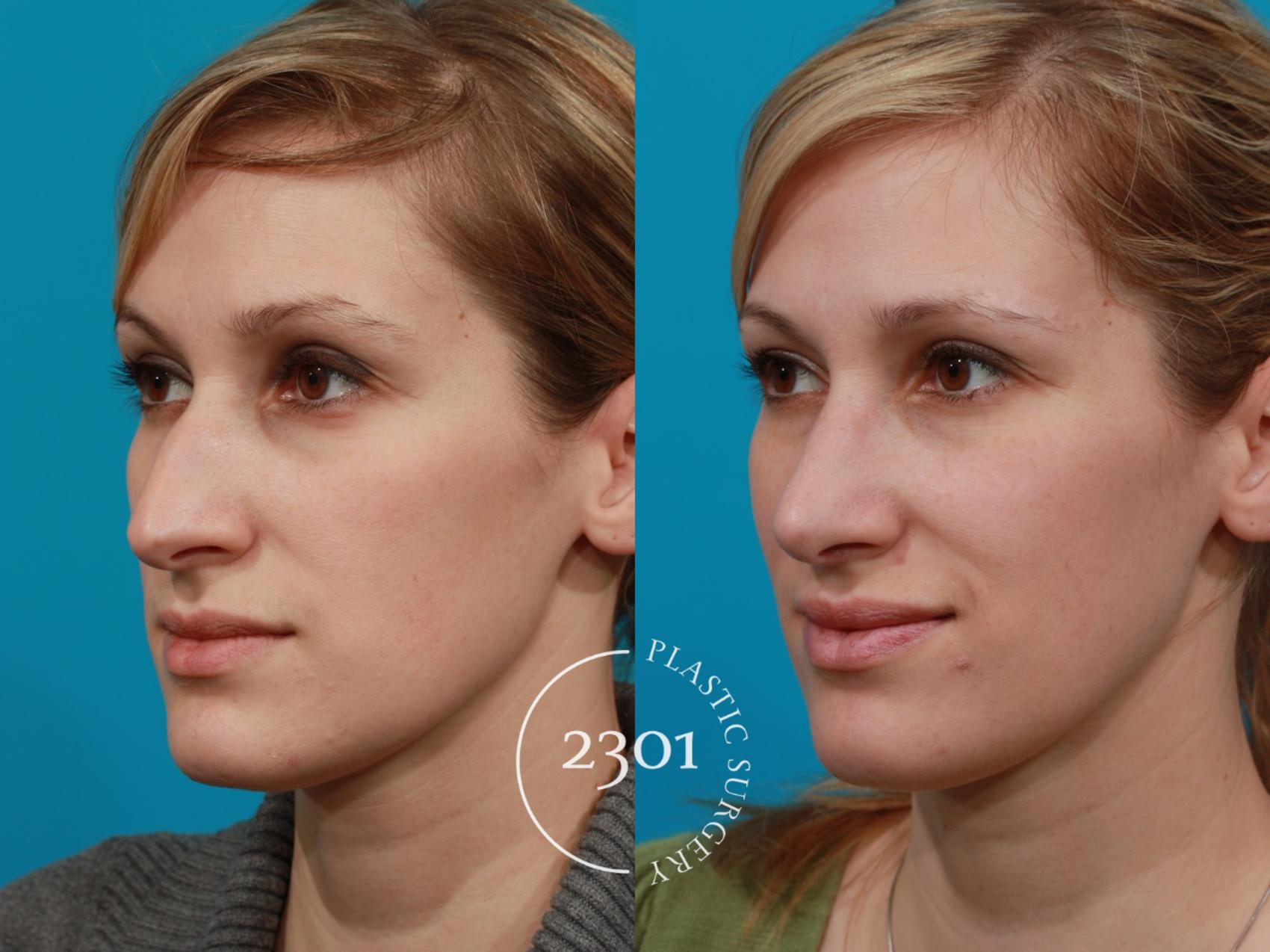 Before & After Rhinoplasty Case 94 View #3 View in Fort Worth, Plano, & Frisco, Texas