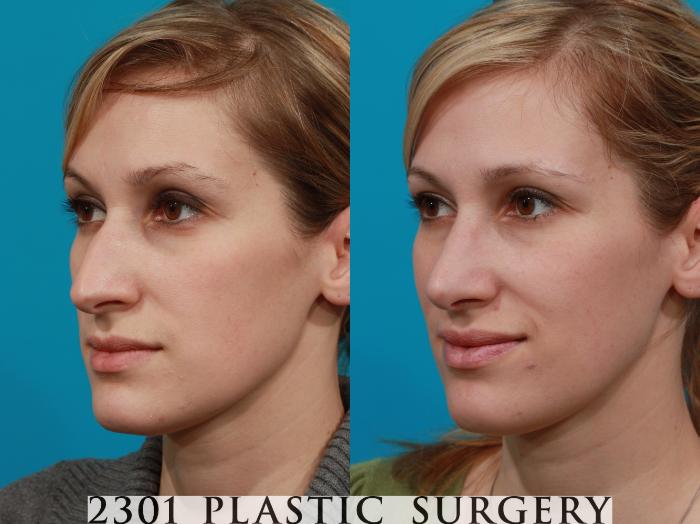 Before & After Rhinoplasty Case 94 View #3 View in Fort Worth, Plano, & Frisco, Texas