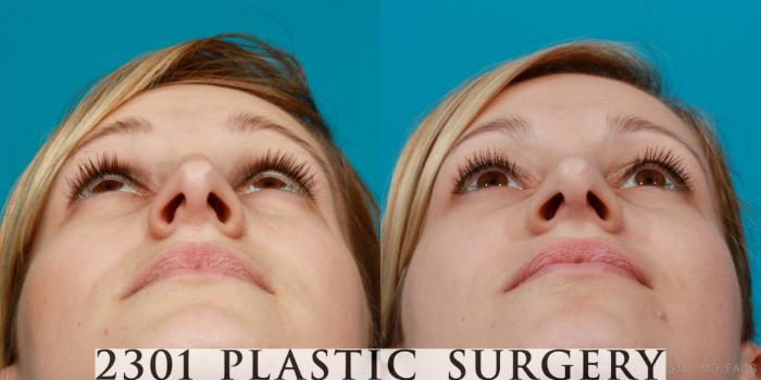 Before & After Rhinoplasty Case 94 View #4 View in Fort Worth, Plano, & Frisco, Texas
