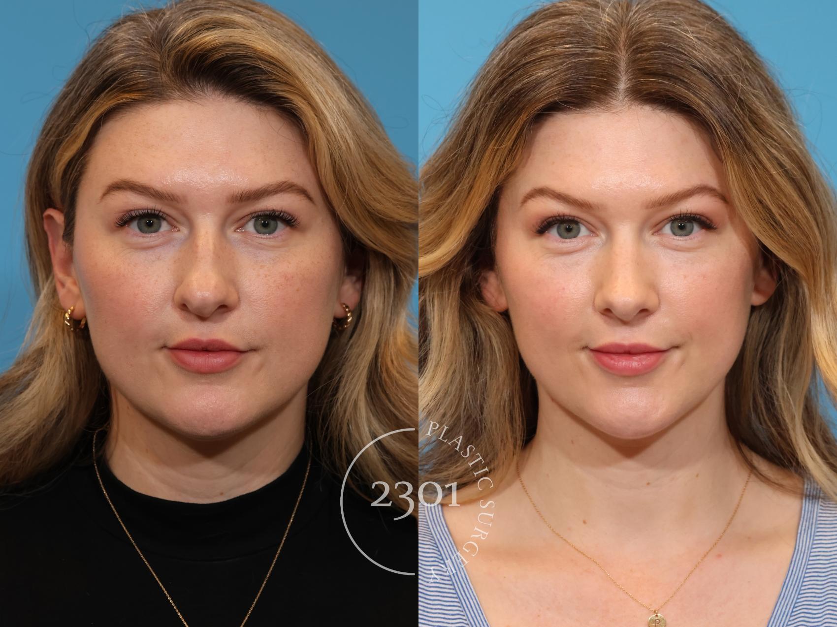 Before & After Rhinoplasty Case 941 Front View in Fort Worth, Plano, & Frisco, Texas