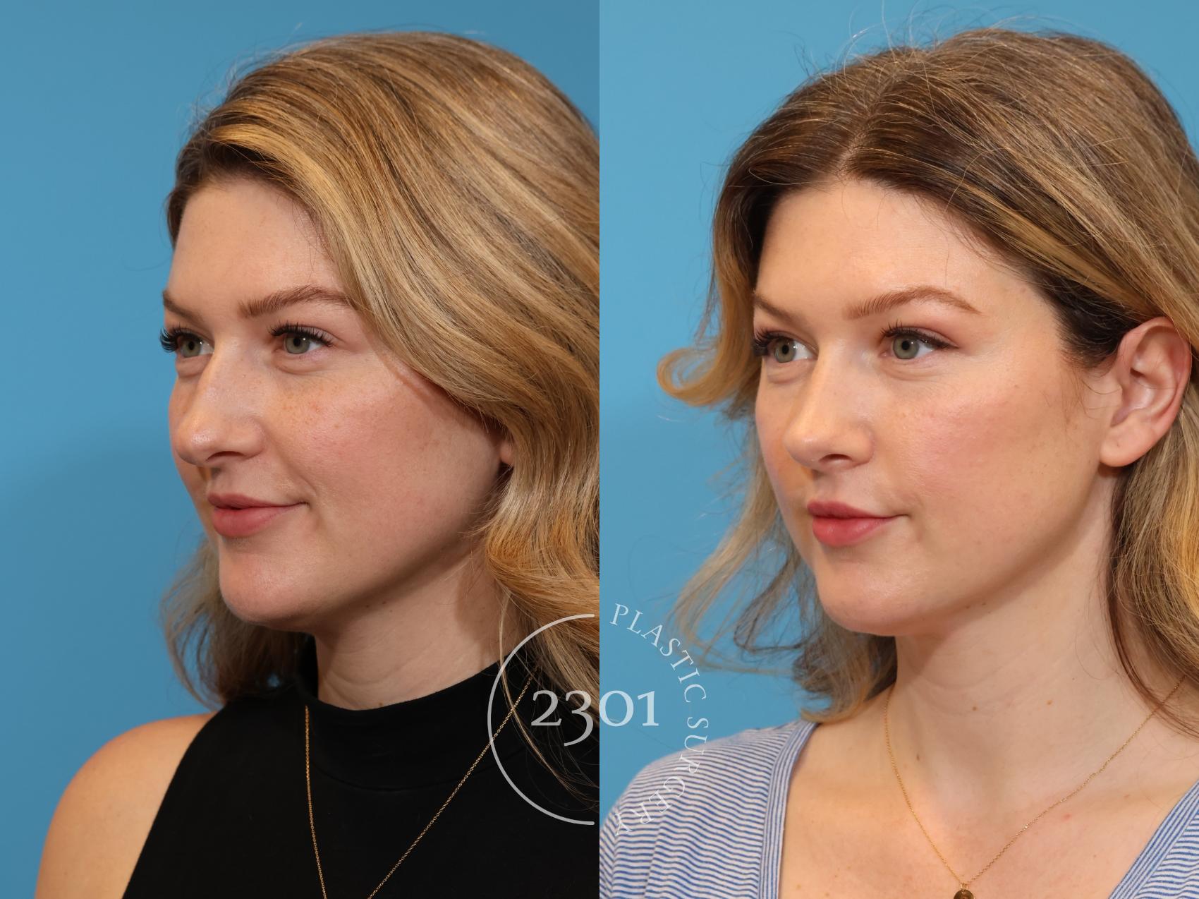 Before & After Rhinoplasty Case 941 Left Oblique View in Fort Worth, Plano, & Frisco, Texas