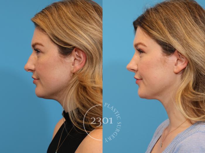Before & After Rhinoplasty Case 941 Left Side View in Fort Worth, Plano, & Frisco, Texas