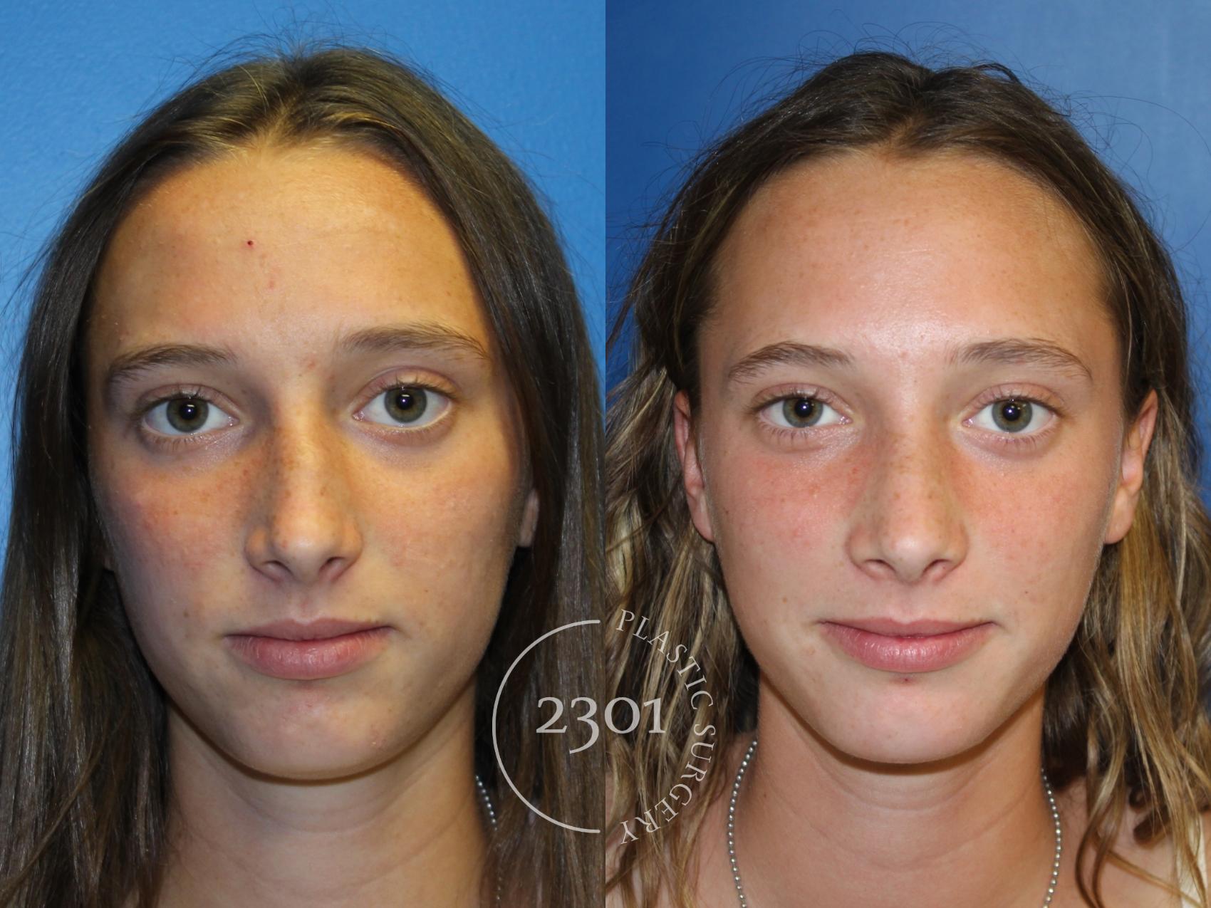 Before & After Rhinoplasty Case 946 Front View in Fort Worth, Plano, & Frisco, Texas