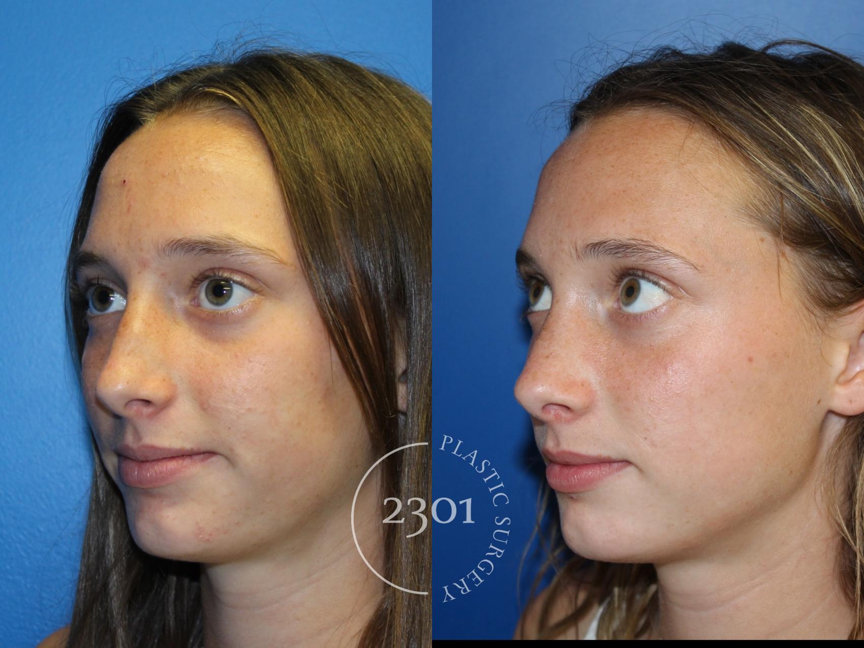Before & After Rhinoplasty Case 946 Left Oblique View in Fort Worth, Plano, & Frisco, Texas