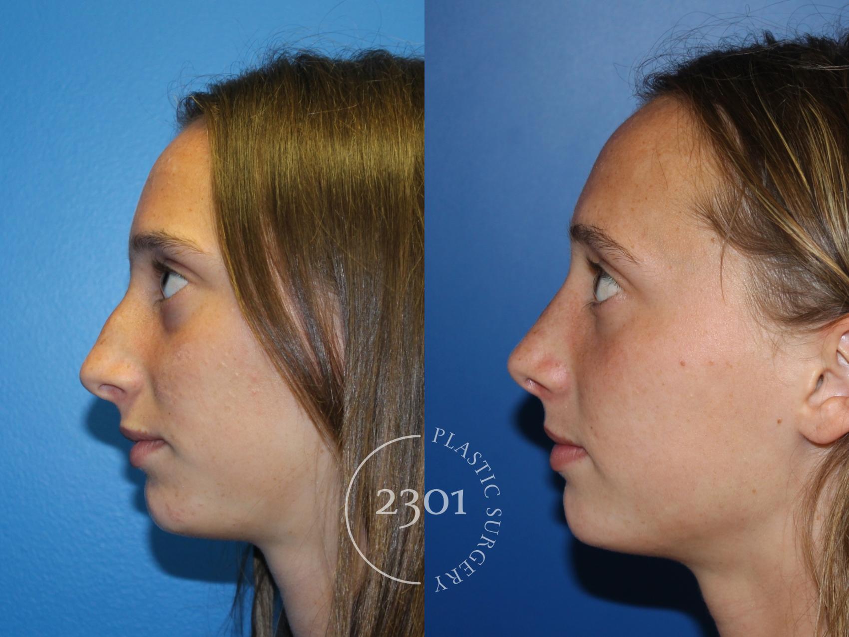 Before & After Rhinoplasty Case 946 Left Side View in Fort Worth, Plano, & Frisco, Texas