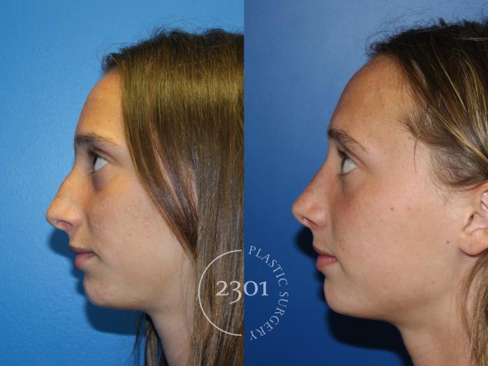 Before & After Rhinoplasty Case 946 Left Side View in Fort Worth, Plano, & Frisco, Texas