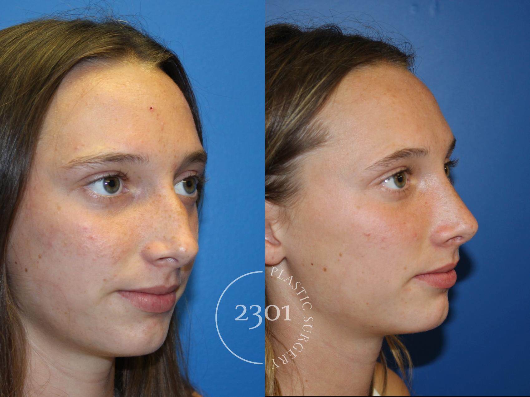 Before & After Rhinoplasty Case 946 Right Oblique View in Fort Worth, Plano, & Frisco, Texas