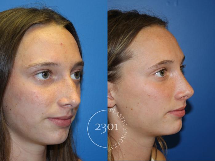 Before & After Rhinoplasty Case 946 Right Oblique View in Fort Worth, Plano, & Frisco, Texas