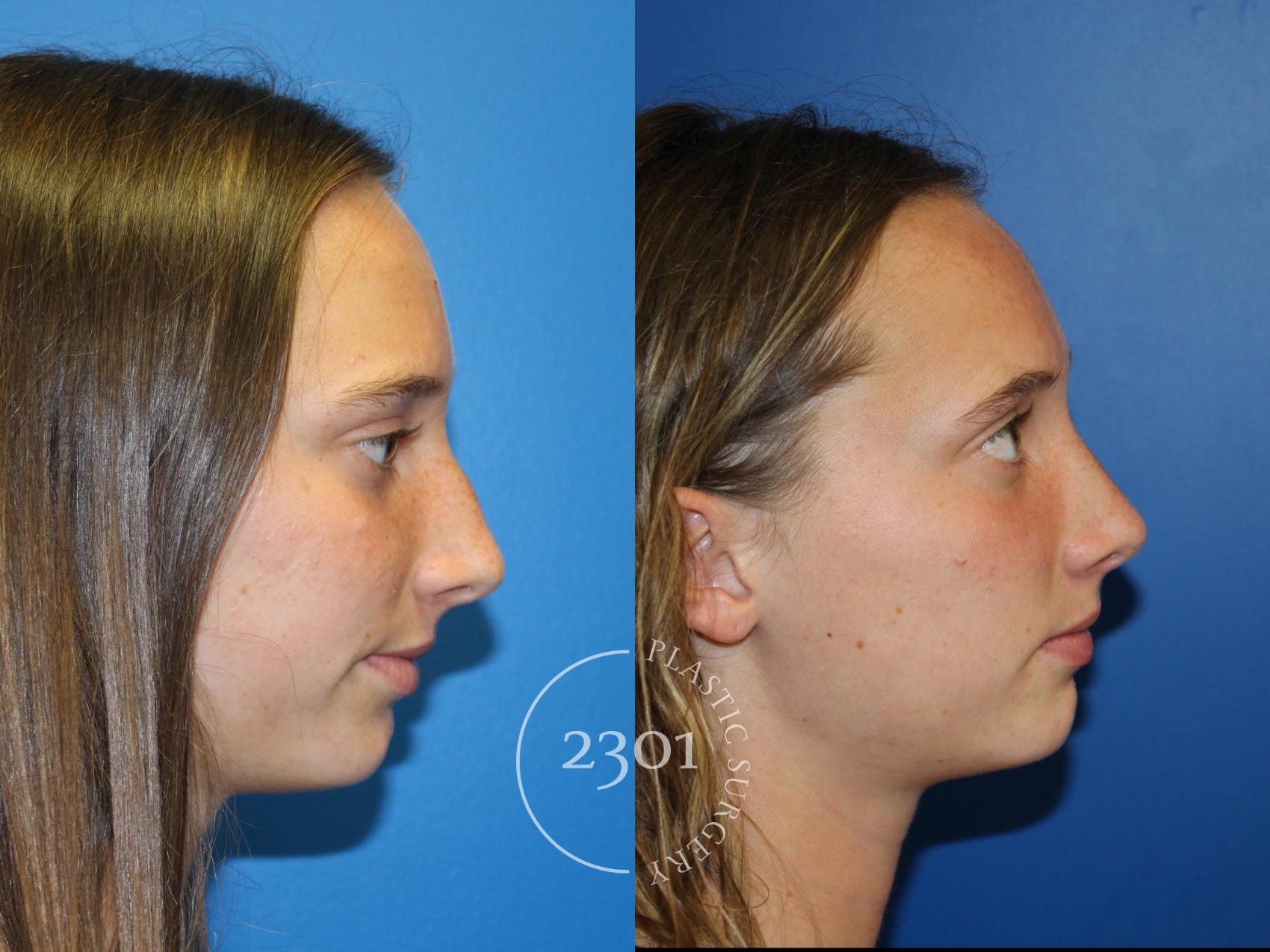 Before & After Rhinoplasty Case 946 Right Side View in Fort Worth, Plano, & Frisco, Texas
