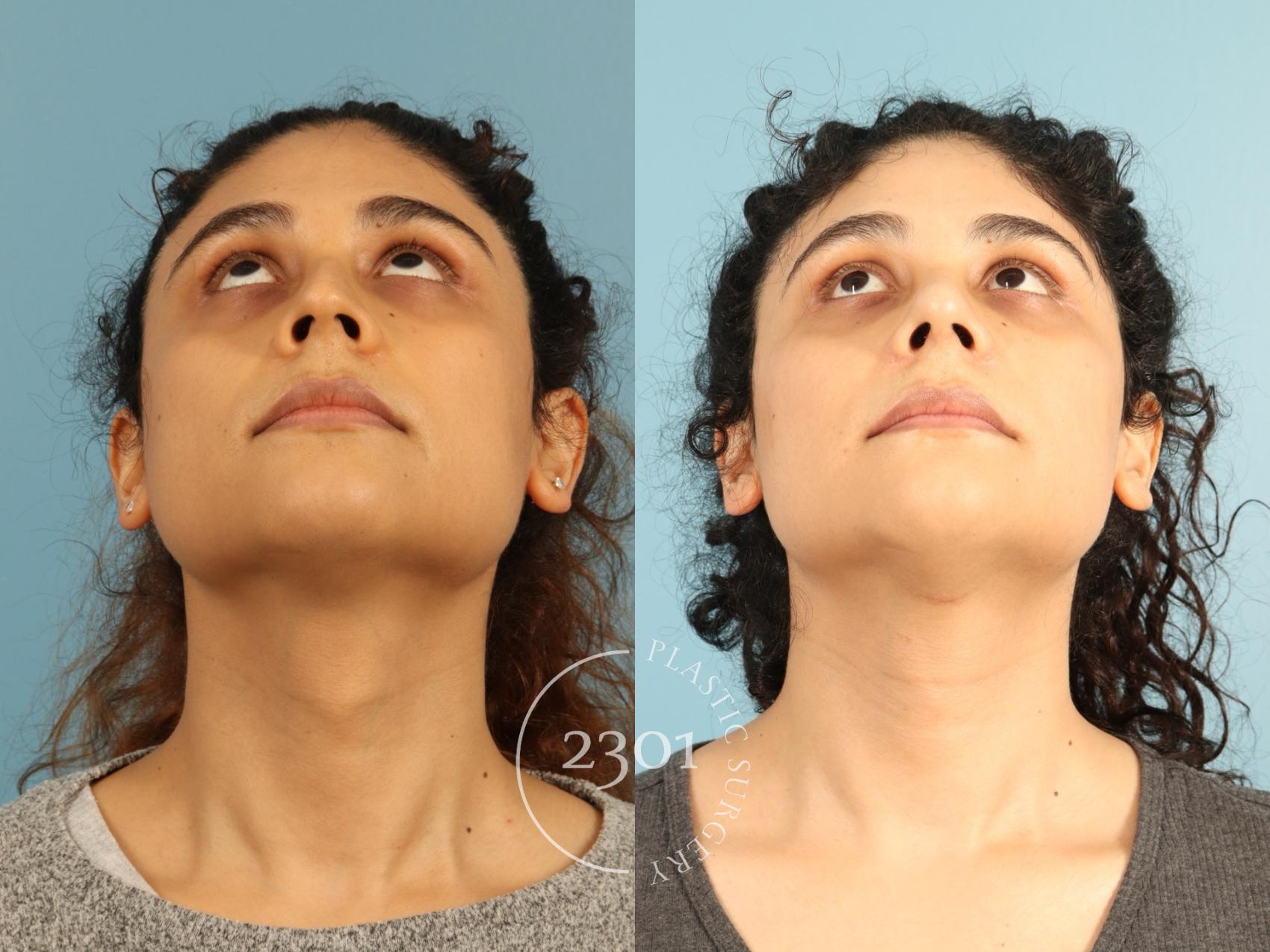 Before & After Rhinoplasty Case 947 Basal view View in Fort Worth, Plano, & Frisco, Texas