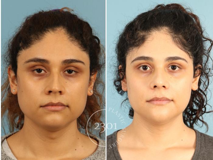 Before & After Rhinoplasty Case 947 Front View in Fort Worth, Plano, & Frisco, Texas