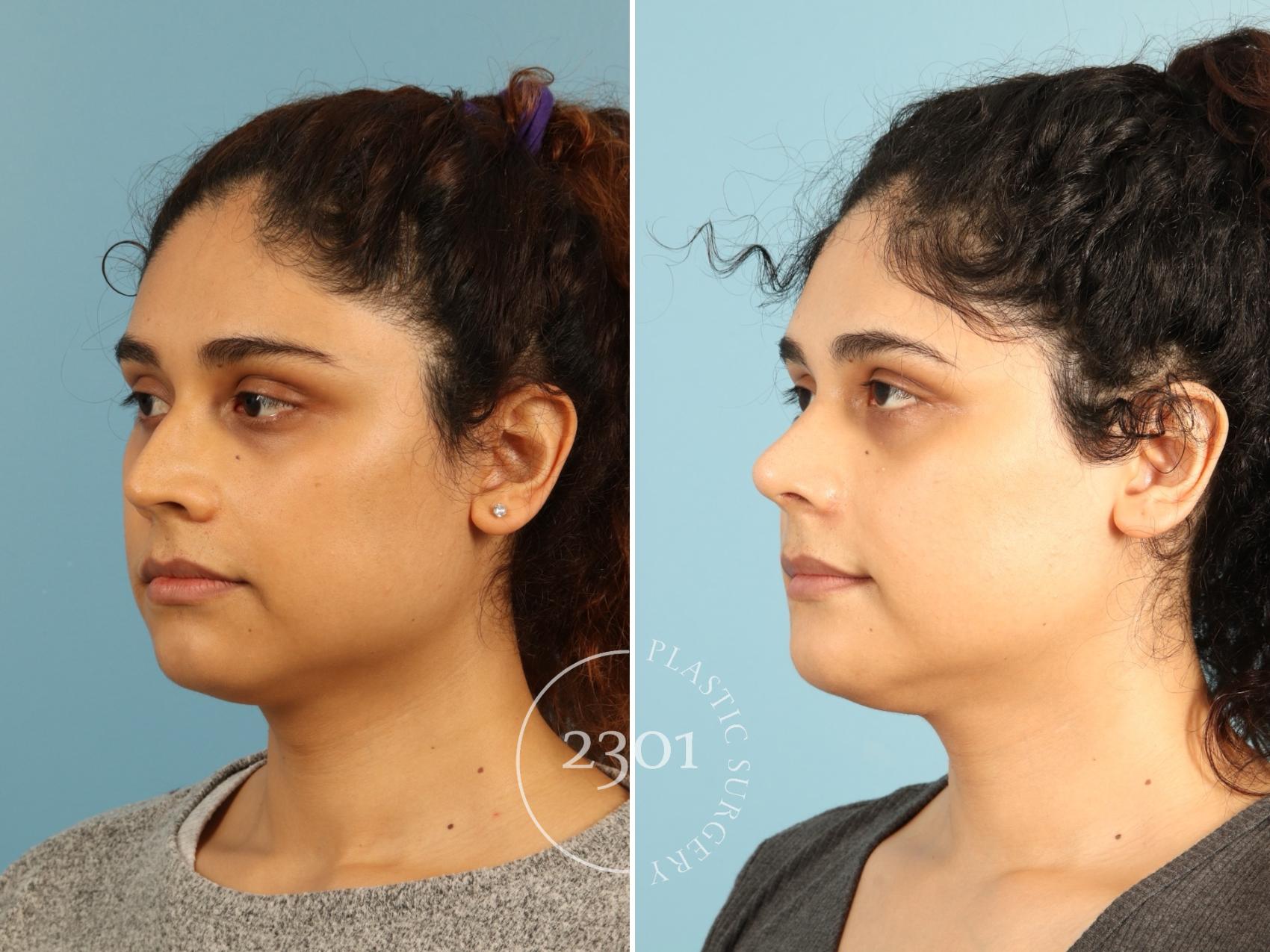 Before & After Rhinoplasty Case 947 Left Oblique View in Fort Worth, Plano, & Frisco, Texas