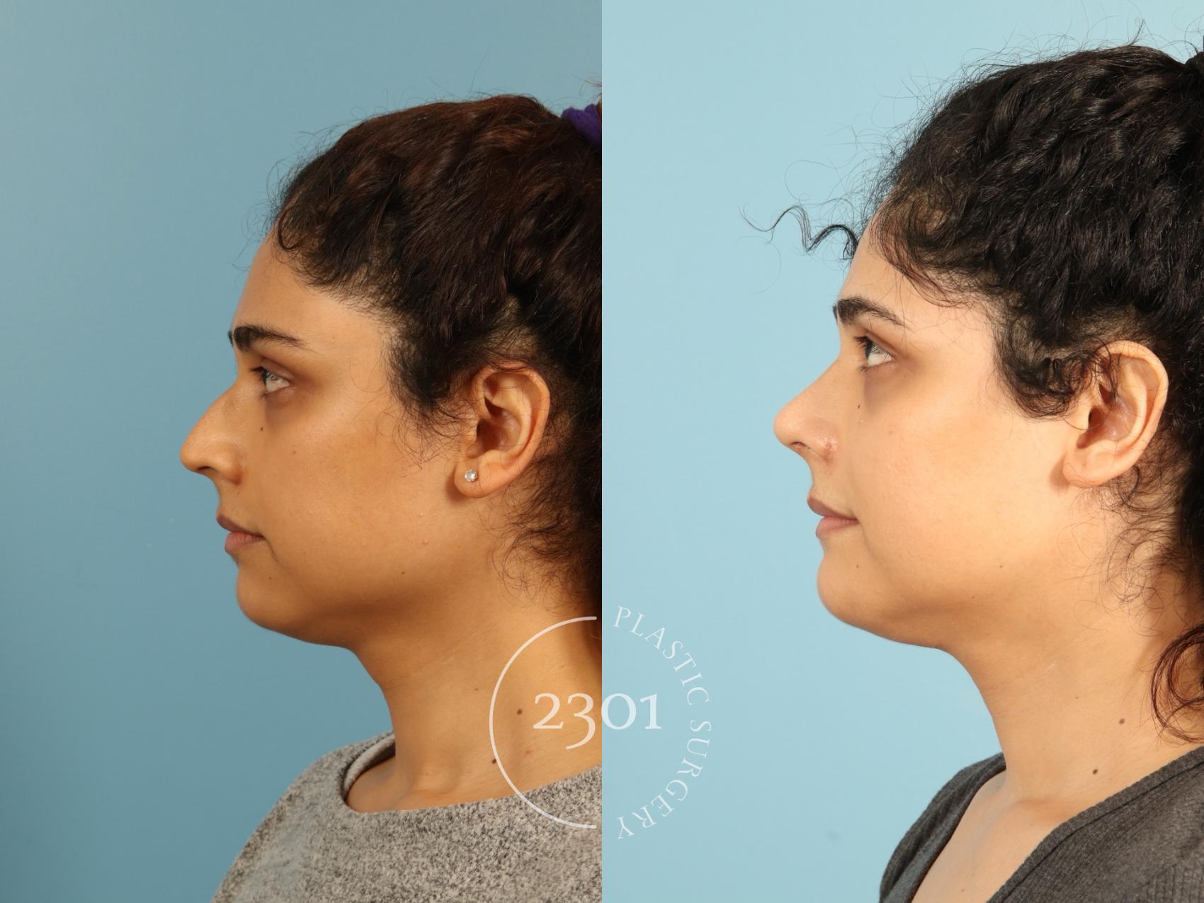 Before & After Rhinoplasty Case 947 Left Side View in Fort Worth, Plano, & Frisco, Texas