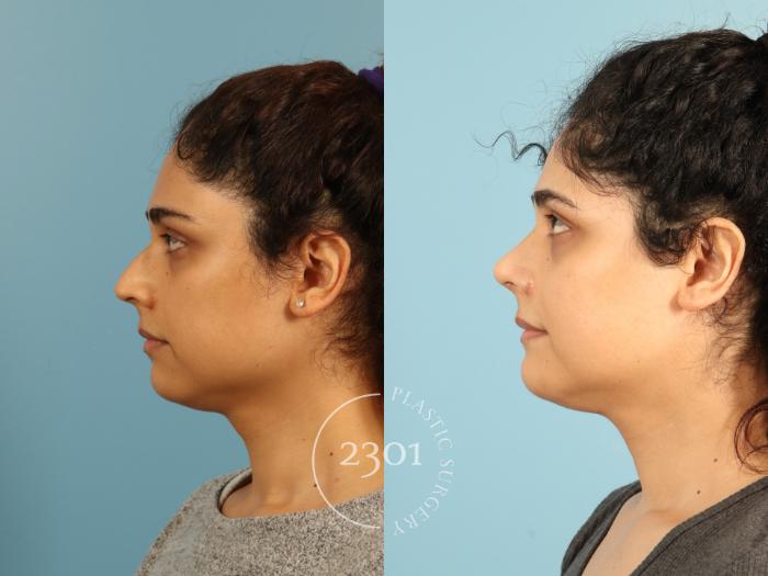 Before & After Rhinoplasty Case 947 Left Side View in Fort Worth, Plano, & Frisco, Texas