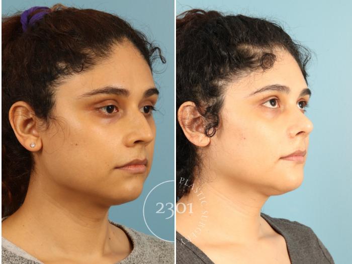 Before & After Rhinoplasty Case 947 Right Oblique View in Fort Worth, Plano, & Frisco, Texas