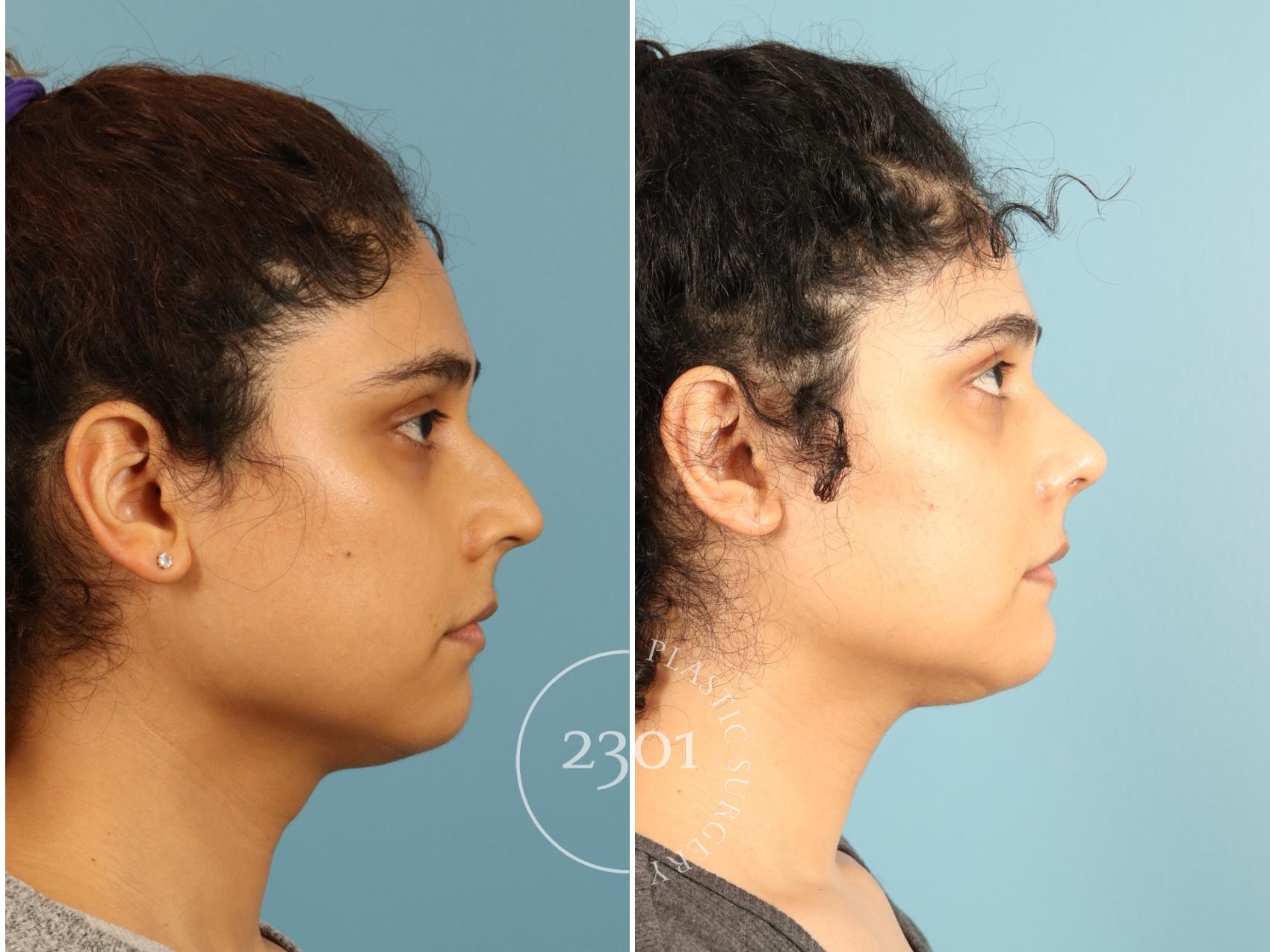 Before & After Rhinoplasty Case 947 Right Side View in Fort Worth, Plano, & Frisco, Texas
