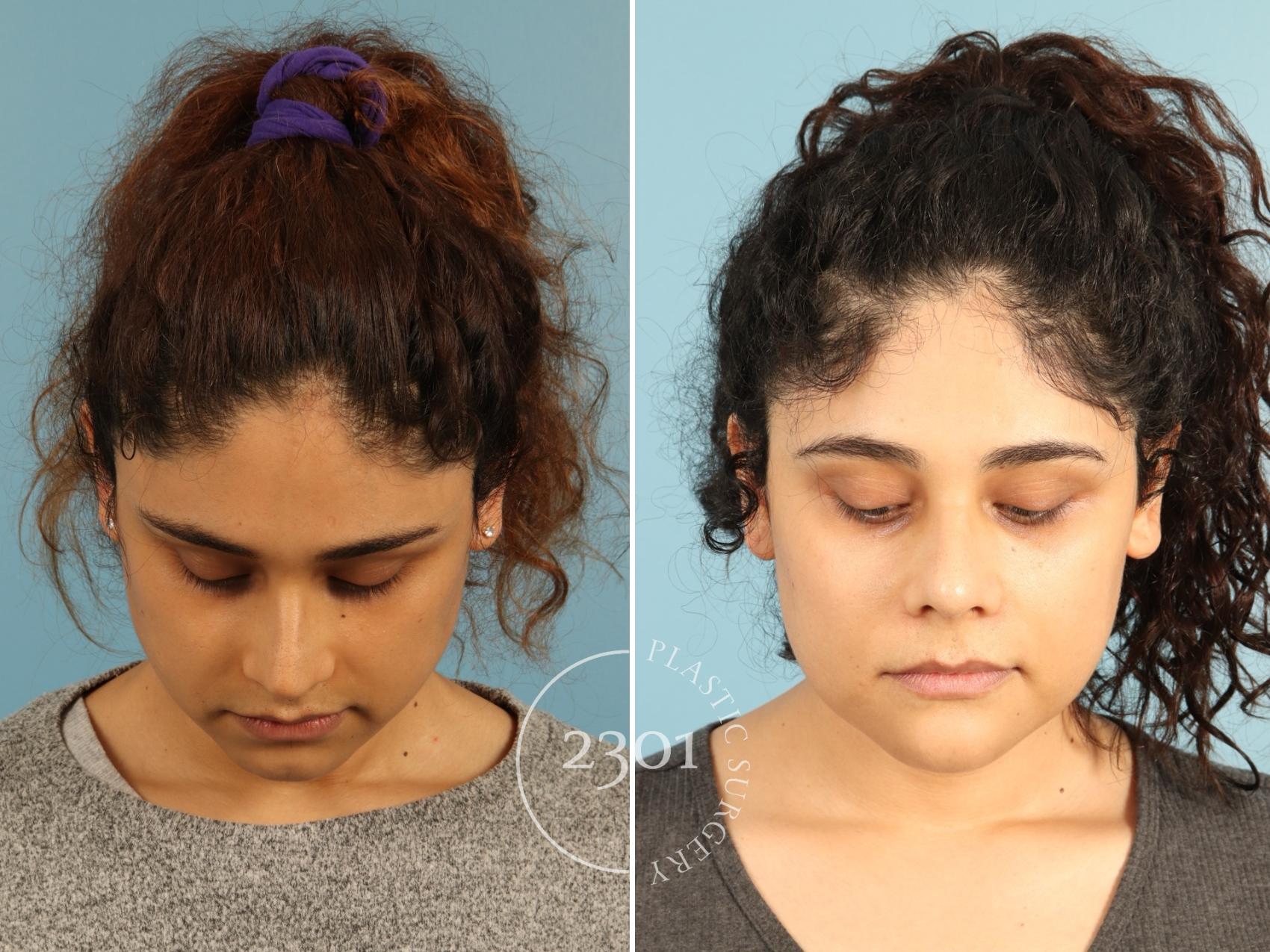 Before & After Rhinoplasty Case 947 Top view View in Fort Worth, Plano, & Frisco, Texas