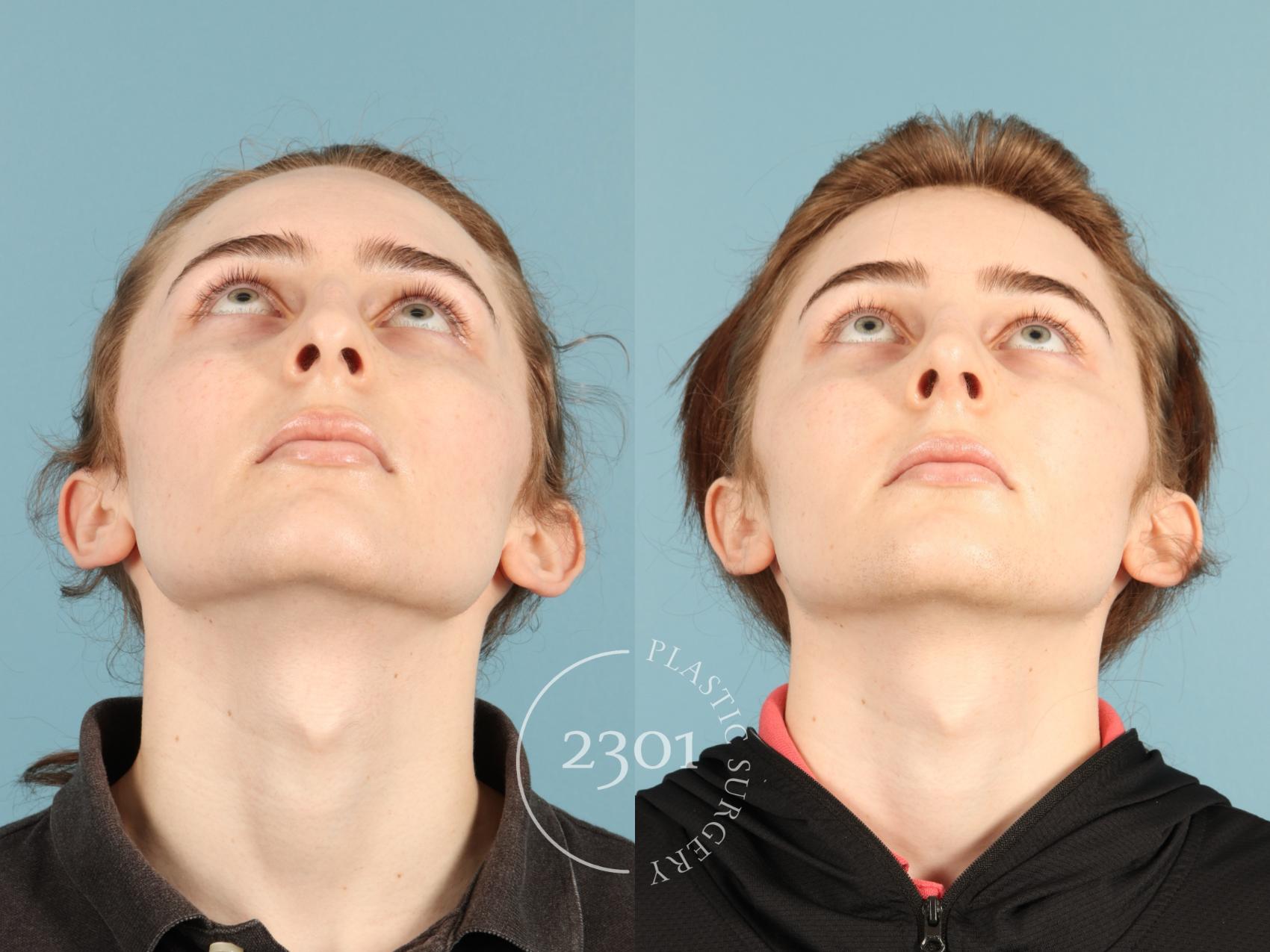 Before & After Rhinoplasty Case 948 Basal view View in Fort Worth, Plano, & Frisco, Texas