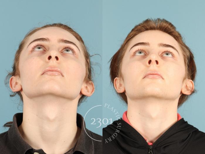 Before & After Rhinoplasty Case 948 Basal view View in Fort Worth, Plano, & Frisco, Texas