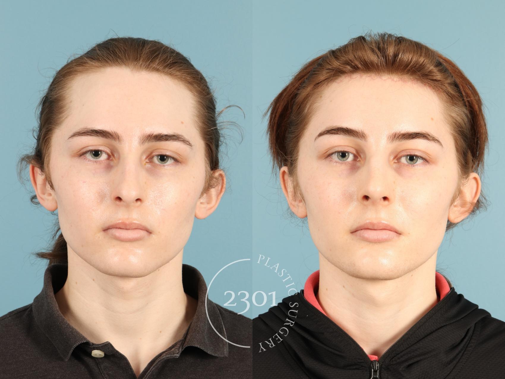 Before & After Rhinoplasty Case 948 Front View in Fort Worth, Plano, & Frisco, Texas