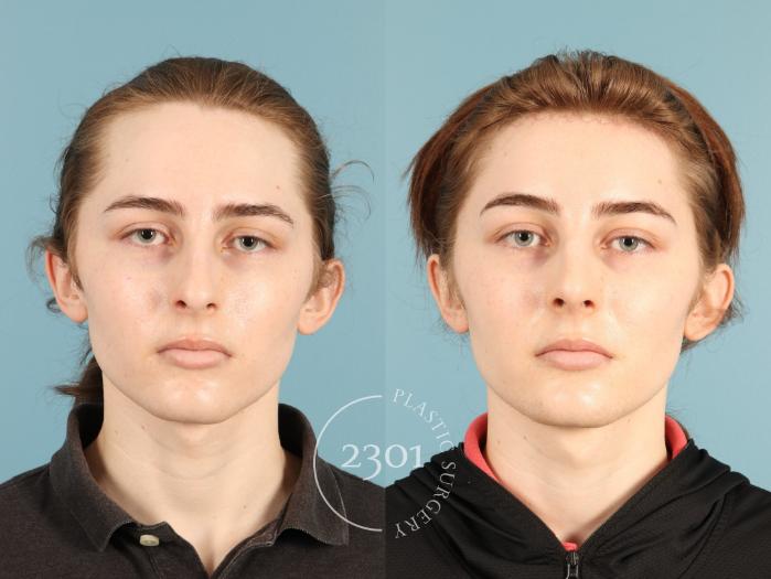 Before & After Rhinoplasty Case 948 Front View in Fort Worth, Plano, & Frisco, Texas