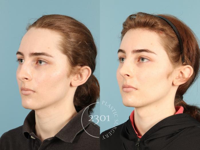 Before & After Rhinoplasty Case 948 Left Oblique View in Fort Worth, Plano, & Frisco, Texas