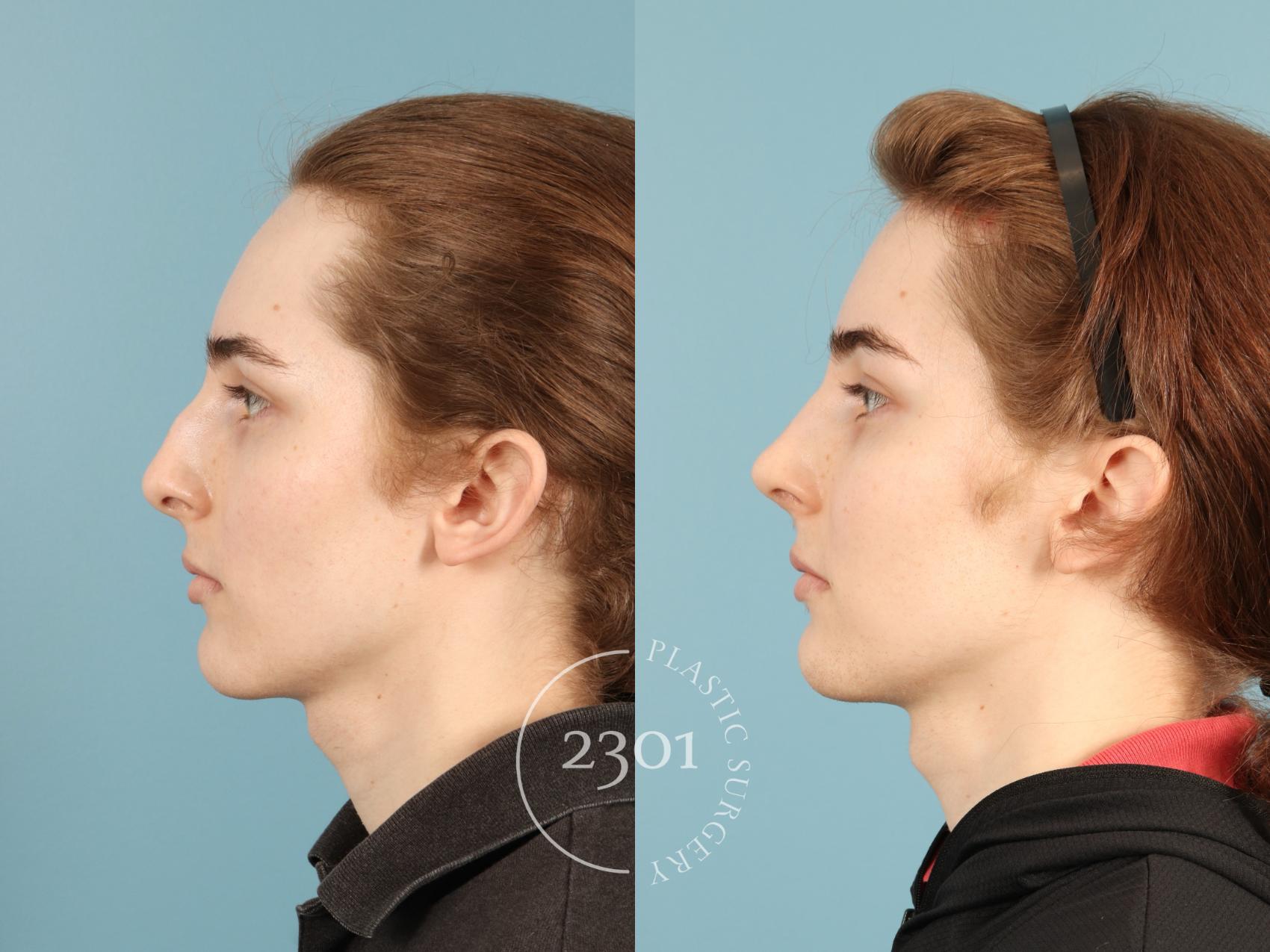 Before & After Rhinoplasty Case 948 Left Side View in Fort Worth, Plano, & Frisco, Texas