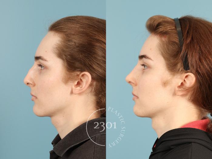 Before & After Rhinoplasty Case 948 Left Side View in Fort Worth, Plano, & Frisco, Texas