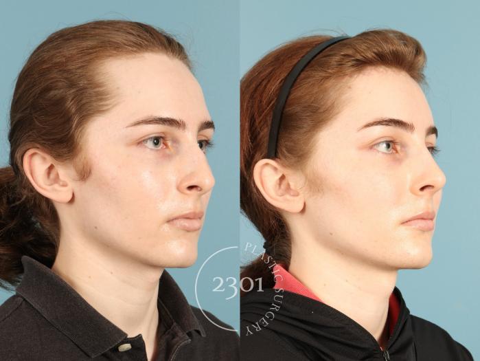 Before & After Rhinoplasty Case 948 Right Oblique View in Fort Worth, Plano, & Frisco, Texas