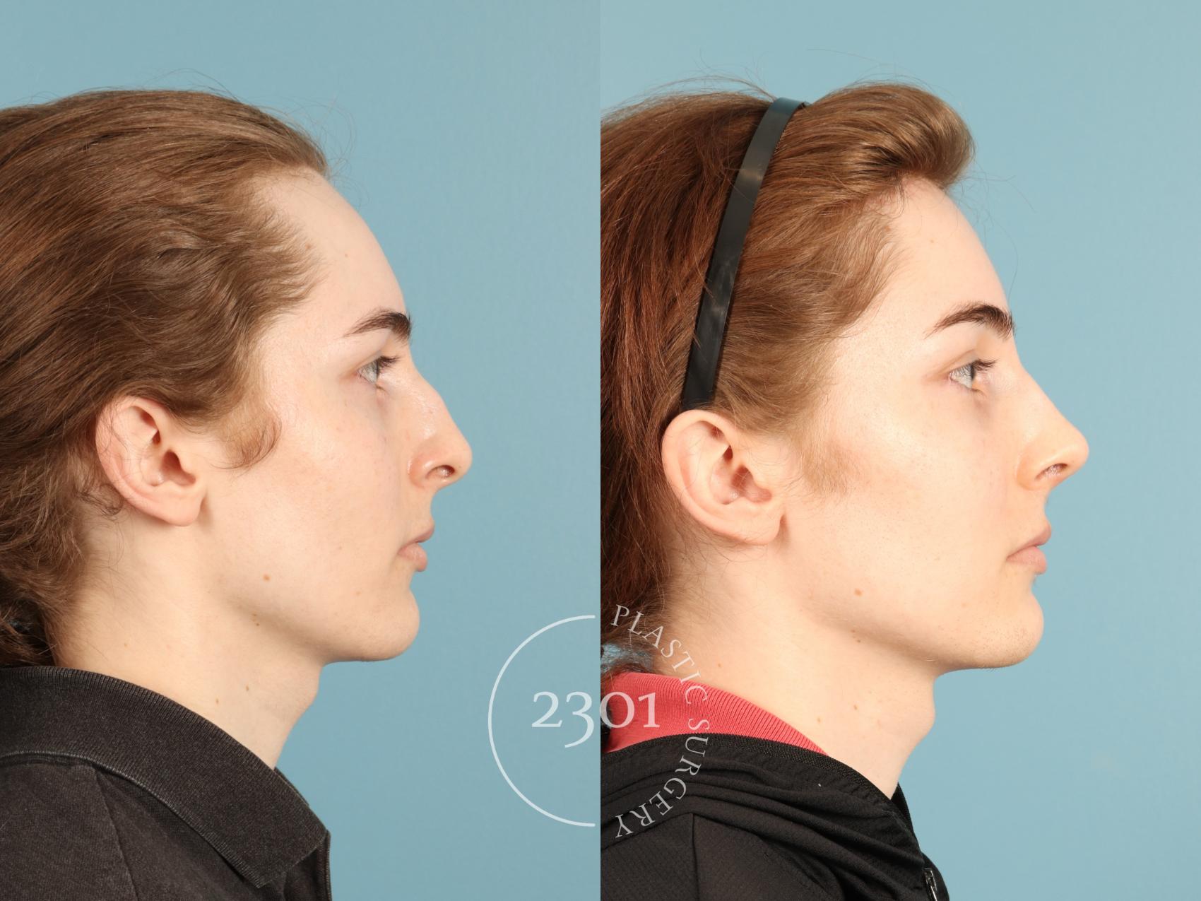 Before & After Rhinoplasty Case 948 Right Side View in Fort Worth, Plano, & Frisco, Texas