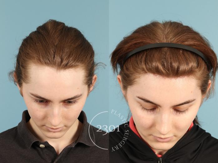 Before & After Rhinoplasty Case 948 Top view View in Fort Worth, Plano, & Frisco, Texas