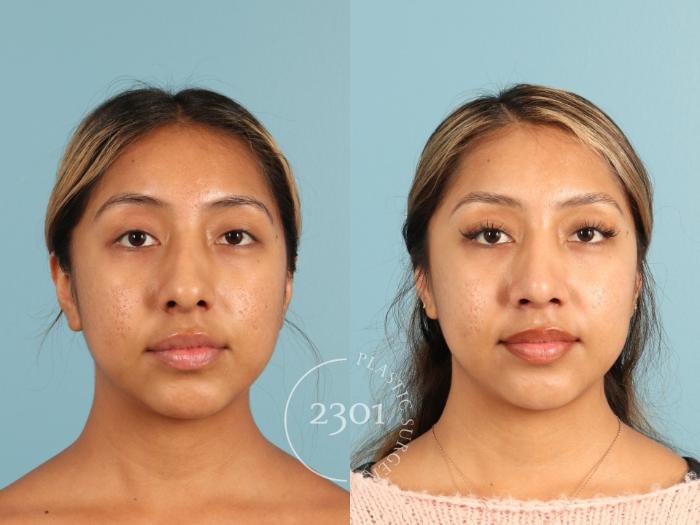 Before & After Rhinoplasty Case 949 Front View in Fort Worth, Plano, & Frisco, Texas