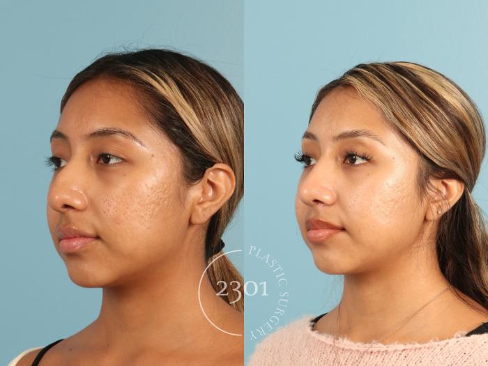 Before & After Rhinoplasty Case 949 Left Oblique View in Fort Worth, Plano, & Frisco, Texas