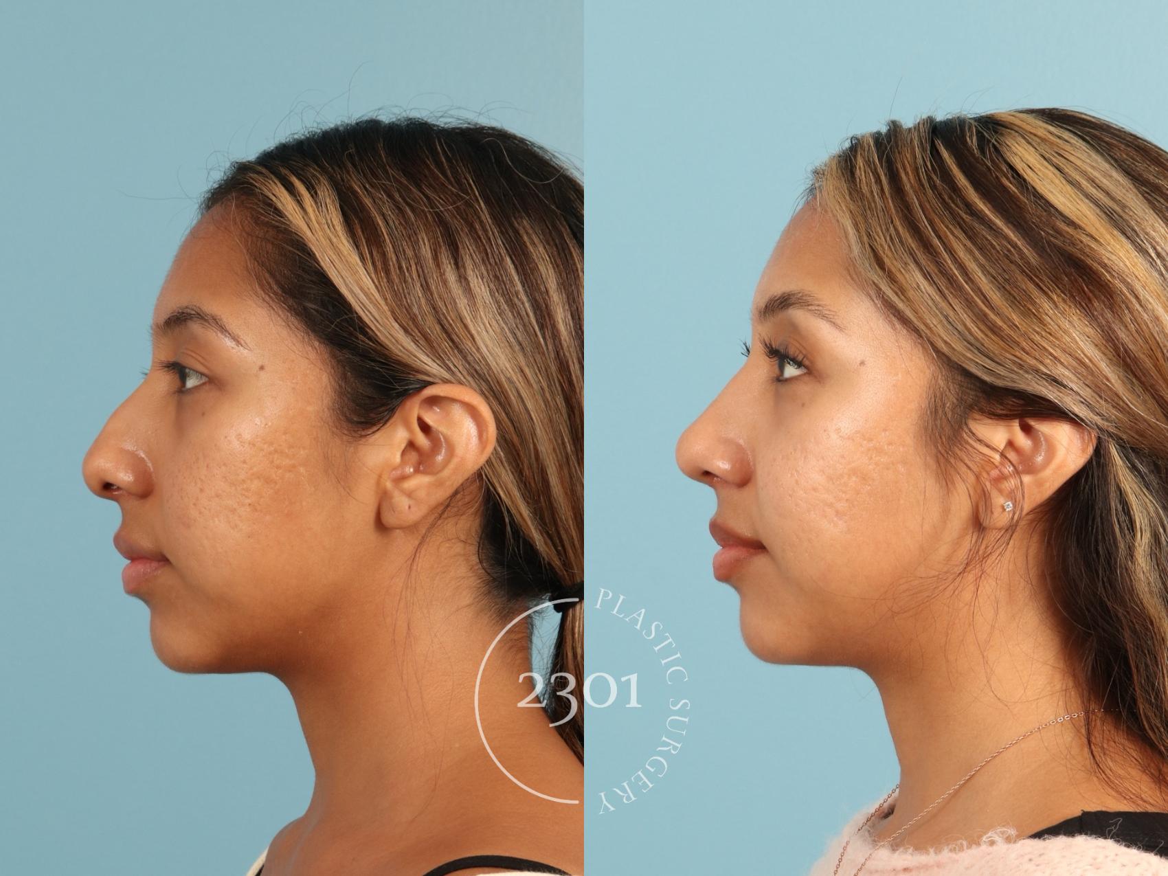 Before & After Rhinoplasty Case 949 Left Side View in Fort Worth, Plano, & Frisco, Texas