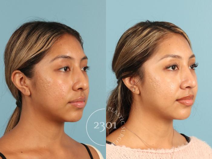 Before & After Rhinoplasty Case 949 Right Oblique View in Fort Worth, Plano, & Frisco, Texas