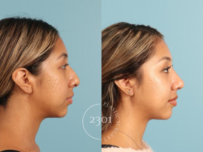 Before & After Rhinoplasty Case 949 Right Side View in Fort Worth, Plano, & Frisco, Texas
