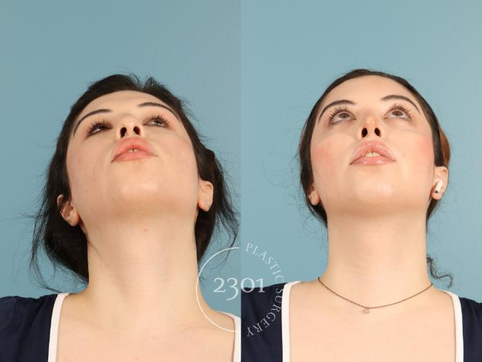Before & After Rhinoplasty Case 950 Basal View in Fort Worth, Plano, & Frisco, Texas