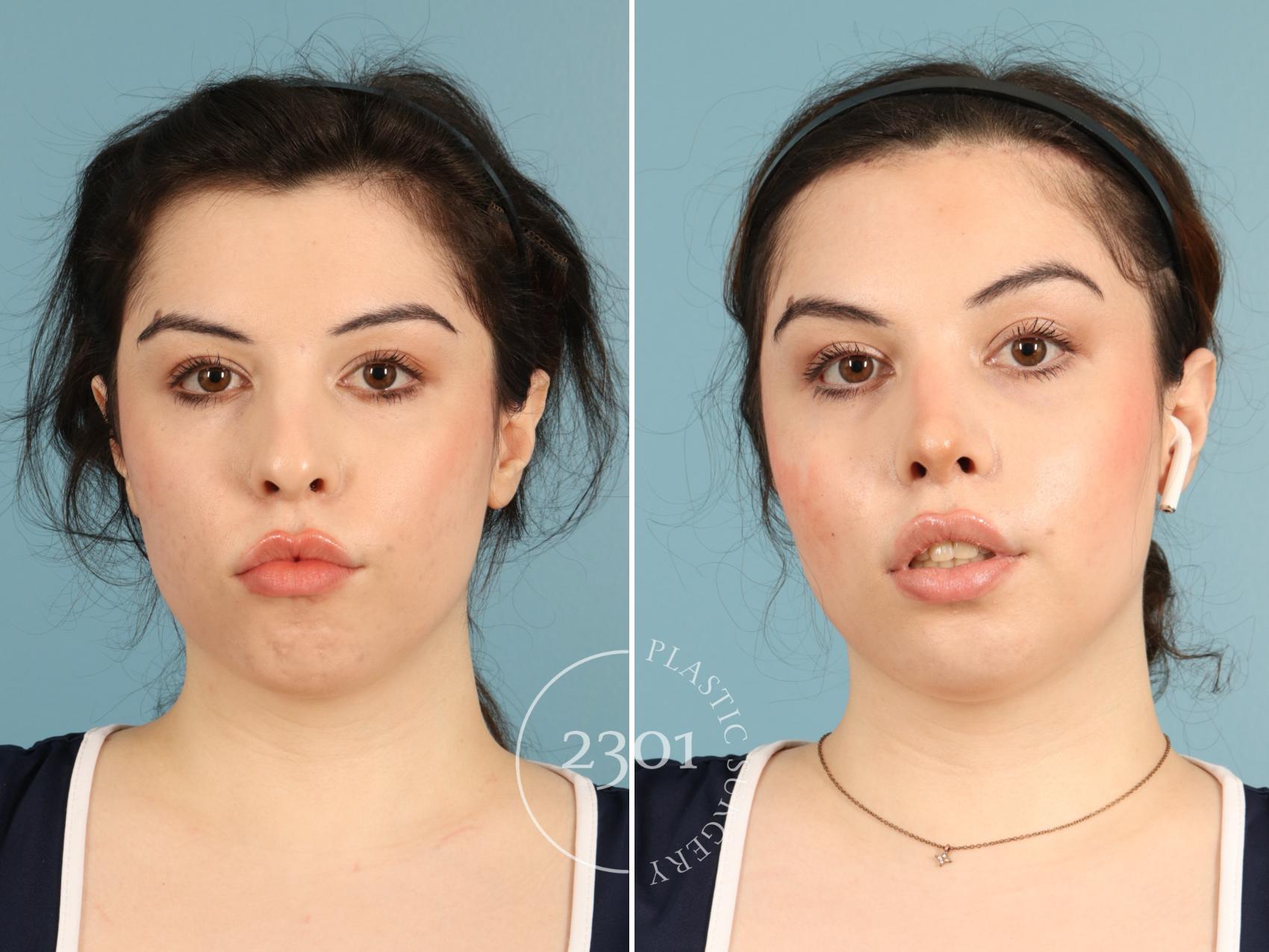 Before & After Rhinoplasty Case 950 Front View in Fort Worth, Plano, & Frisco, Texas