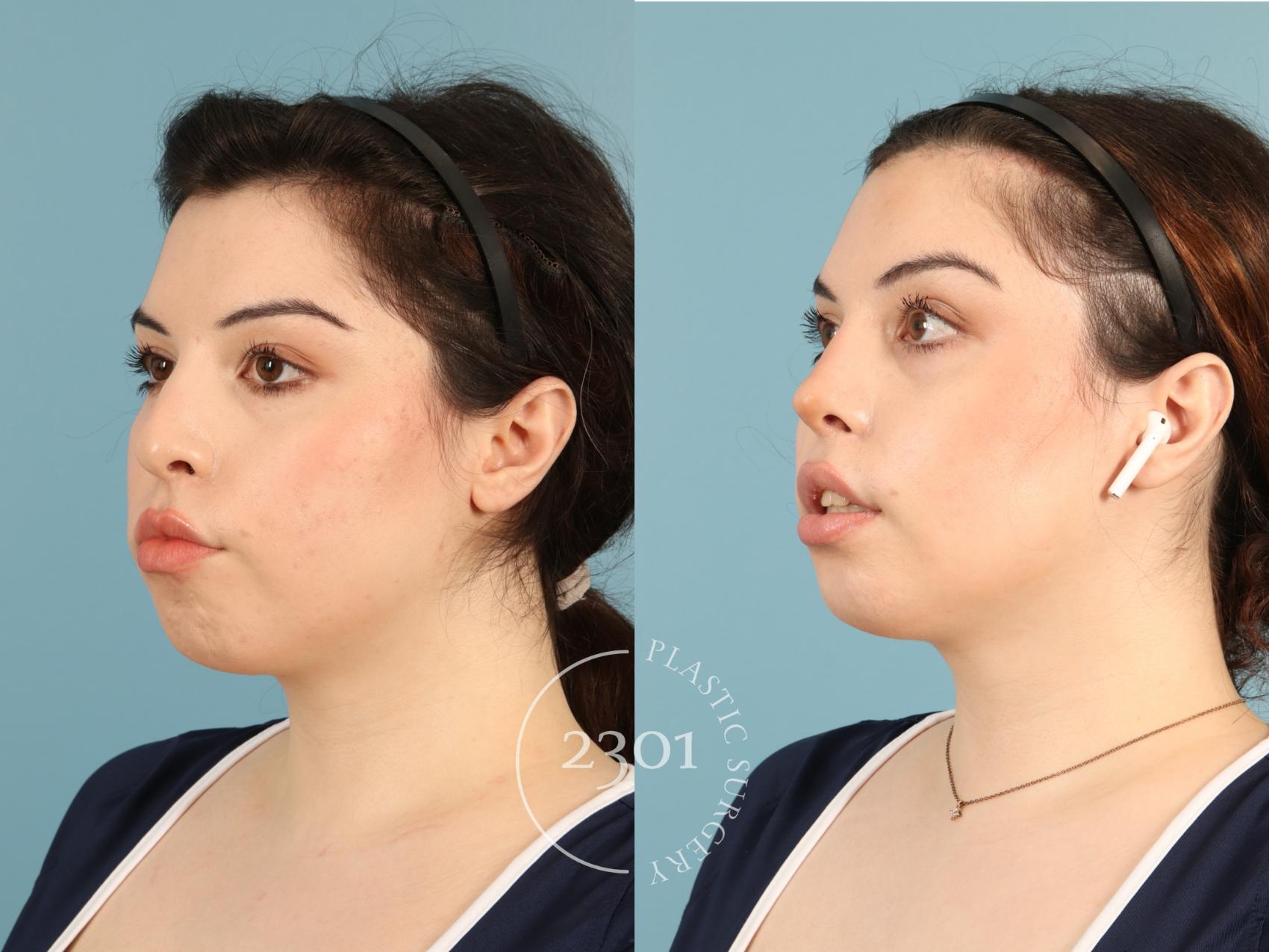 Before & After Rhinoplasty Case 950 Left Oblique View in Fort Worth, Plano, & Frisco, Texas