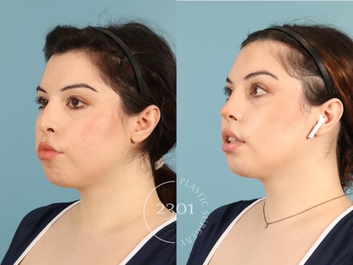 Before & After Rhinoplasty Case 950 Left Oblique View in Fort Worth, Plano, & Frisco, Texas