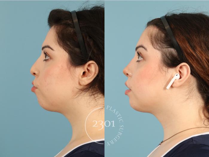 Before & After Rhinoplasty Case 950 Left Side View in Fort Worth, Plano, & Frisco, Texas