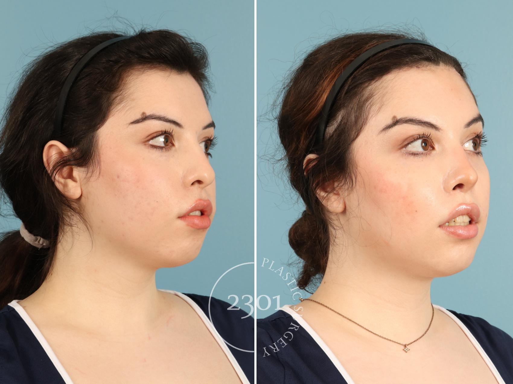 Before & After Rhinoplasty Case 950 Right Oblique View in Fort Worth, Plano, & Frisco, Texas