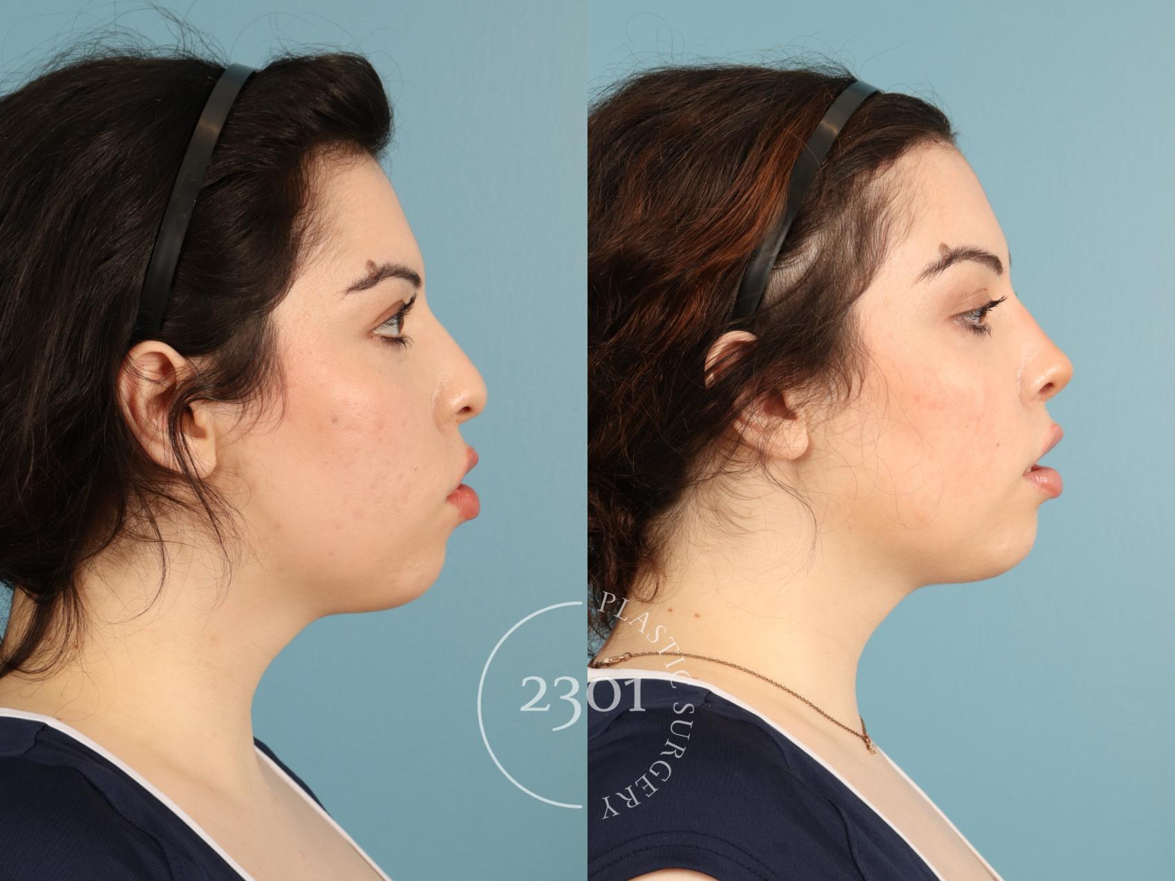 Before & After Rhinoplasty Case 950 Right Side View in Fort Worth, Plano, & Frisco, Texas