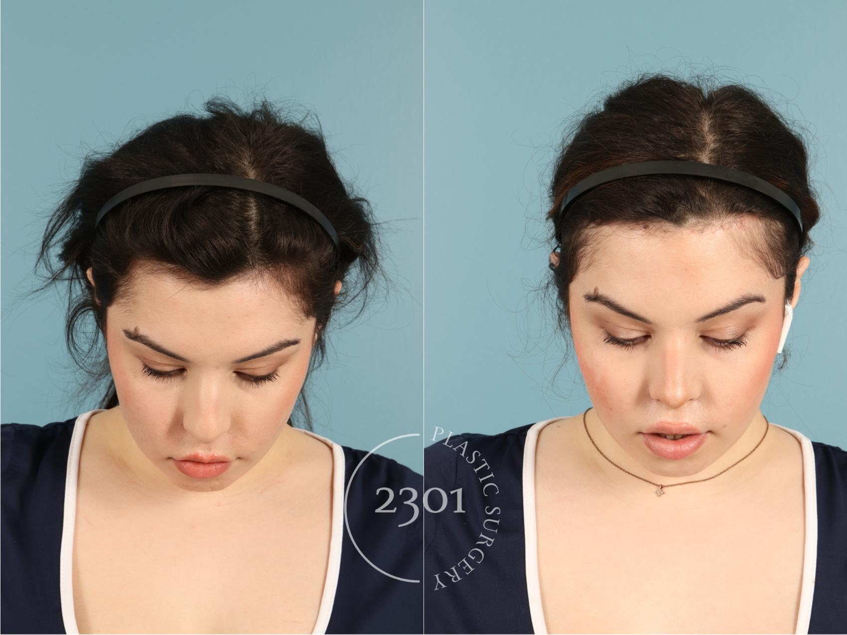 Before & After Rhinoplasty Case 950 Top  View in Fort Worth, Plano, & Frisco, Texas